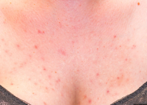 胸に赤いできもののようなしこりが出来ました。 - 左の胸の乳輪の端に赤い- Yahoo!知恵袋