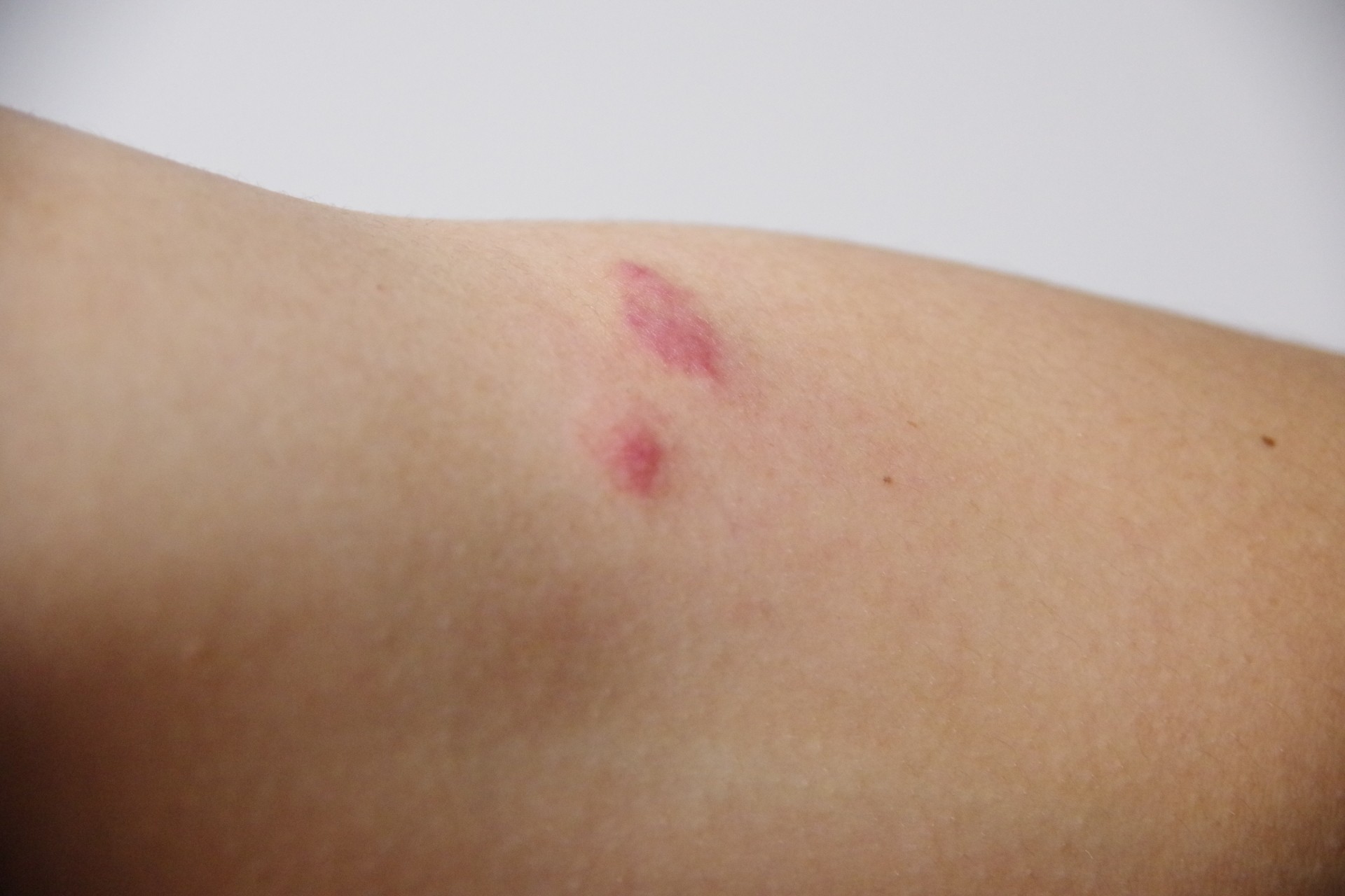 蚊に刺された跡がシミのようになって冬まで残っている│アンファーからだエイジング 専門ドクター監修