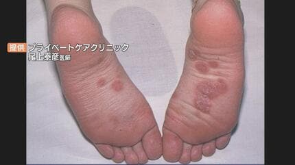 女性の梅毒写真・画像で追う初期から晩期までの症状 – プライベートクリニック高田馬場 – 東京都新宿区