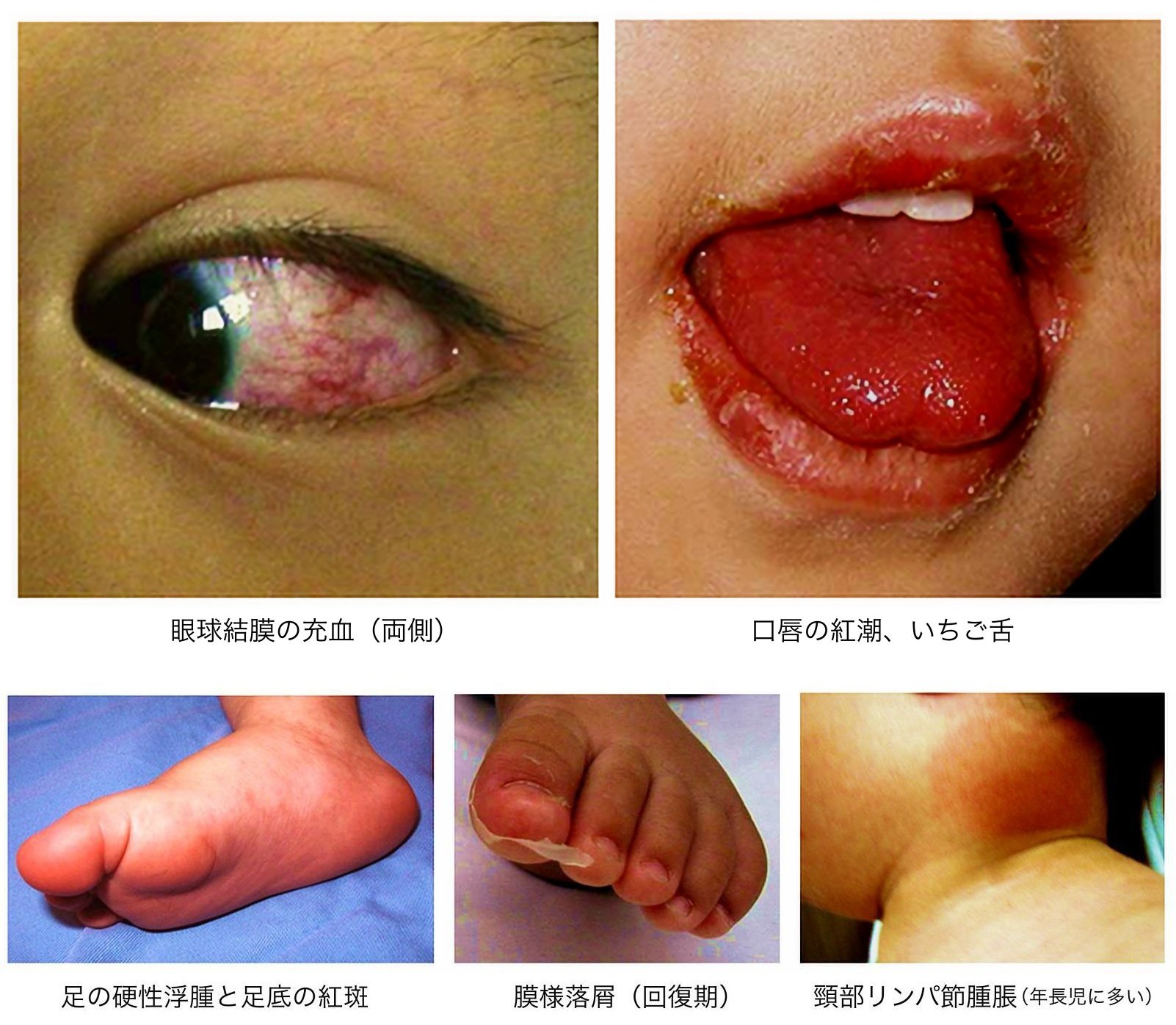 川崎病について - 独立行政法人国立病院機構 四国こどもとおとなの医療センタ