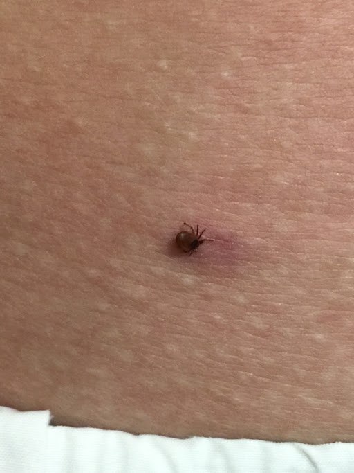 子どもの虫刺されで水ぶくれ？原因と対処法を解説 ベスタの小児科医が解説- 練馬の小児科365日診療 ベスタ アレルギー・夜尿症専門外来