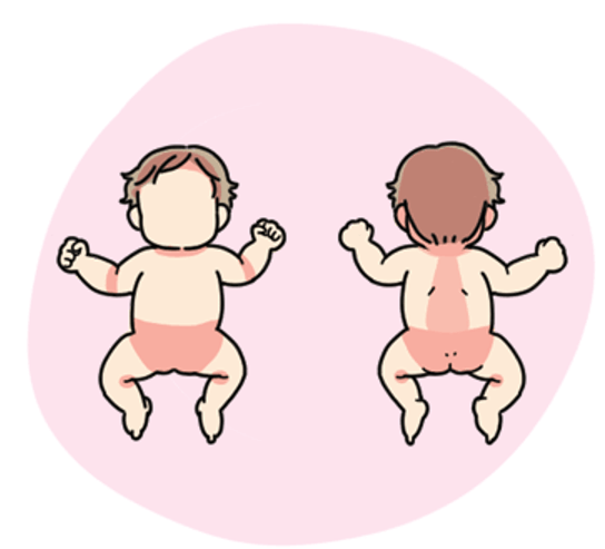 赤ちゃんの湿疹、原因は乳児湿疹以外にも！注意するべきことって？美的.com