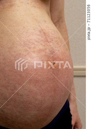 皮膚画像検索 │ ひふ研 「ひふ症状、ひふ薬の使い方の疑問に答える情報サイト」 │ 第一三共ヘルスケア