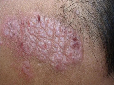 第 43 回日本小児皮膚科学会 ① シンポジウム１ 丘疹・結節・局面から考える見逃しやすい小