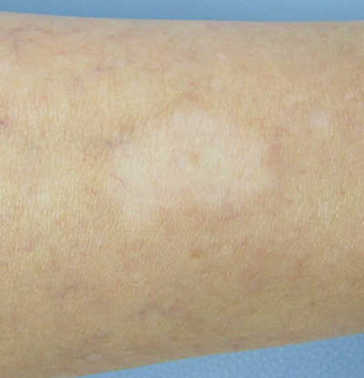 尋常性白斑でお困りの方は最新のエキシマ光線治療対応の はなふさ皮膚科 にご相談下さい。粉瘤・ほくろ除去で皮膚科をお探しなら はなふさ皮膚科へ