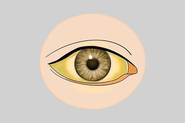 眼睛发黄的病因是什么？ - 病症知识- 轻壹