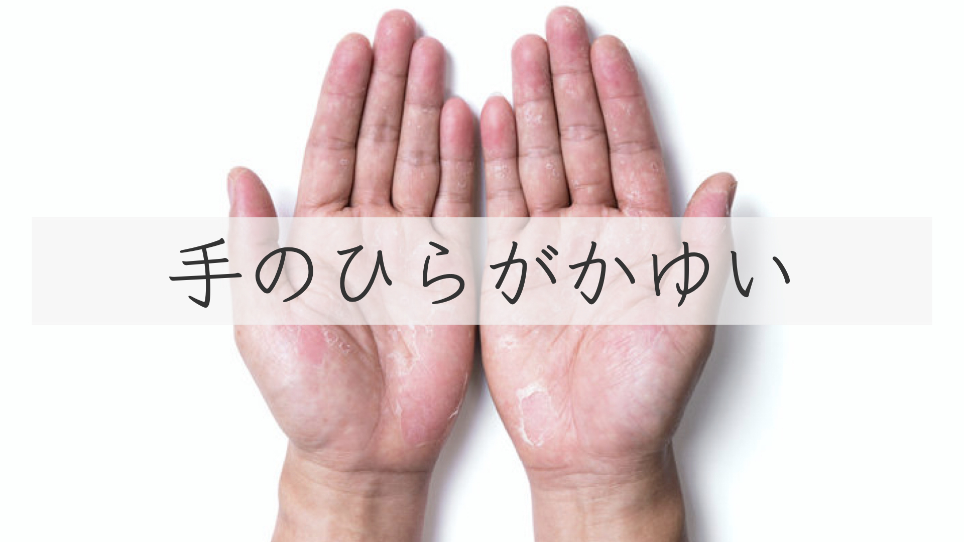 手のガサガサが良くなりません。どうすれば？：日経メディカル