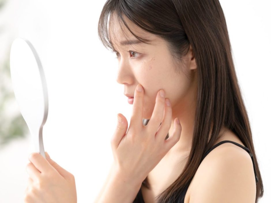 そばかすの原因とシミとの違い・セルフケア・除去方法を紹介あさ美皮フ科亀戸駅前