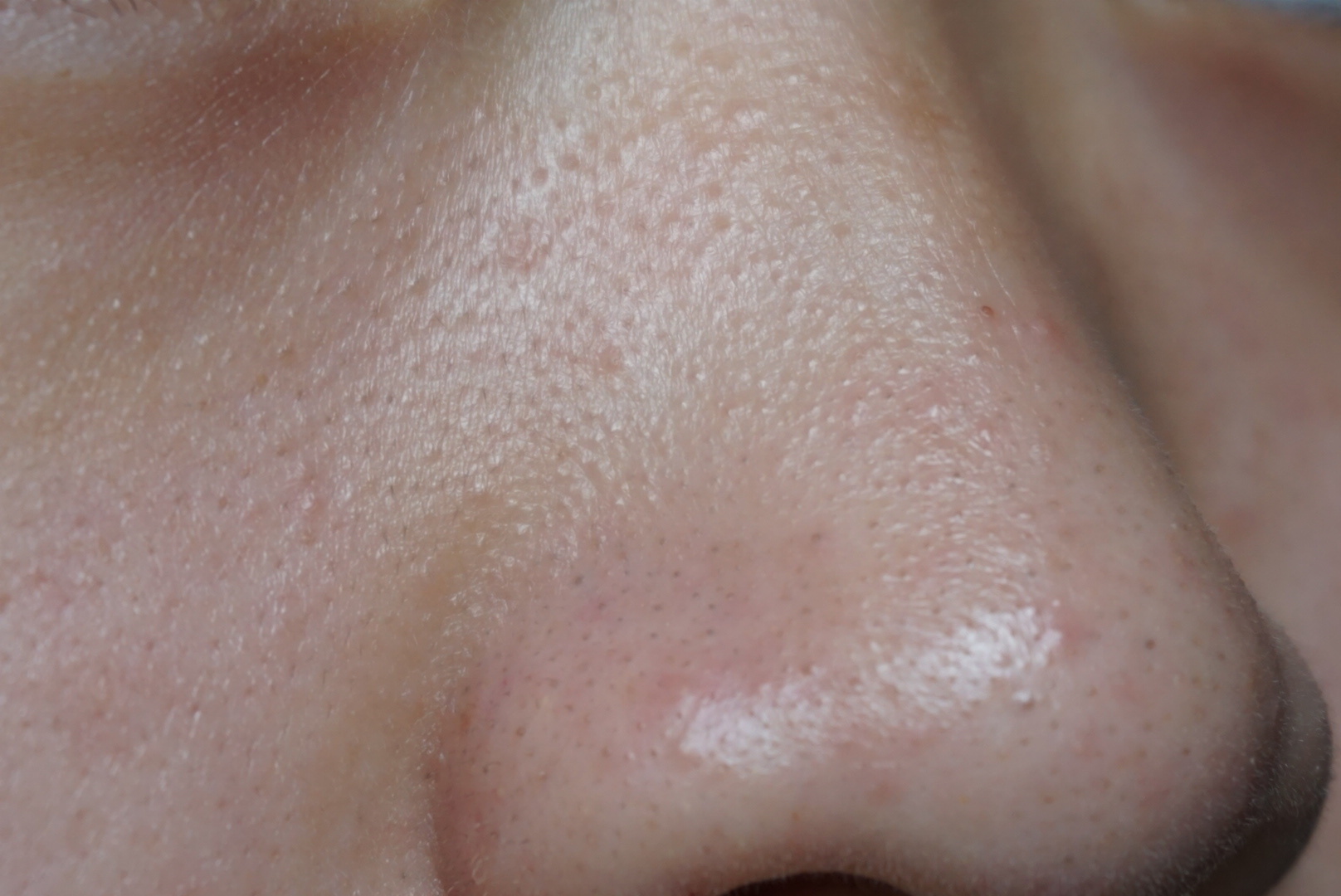 鼻 ブツブツ」の4.7万点のロイヤリティフリー画像、写真素材、絵Shutterstock