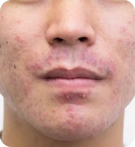 ほうれい線のシワや頬コケに効果的なレ二スナとヒアルロン酸の違いを解説！ - 池袋駅前のだ皮膚科ークリニックコラム