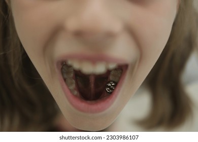 17歳女性 高校2年生 「歯並びが悪いのが気になる」ワイヤー矯正器具で治療した症例大田区糀谷の歯医者なら伴場歯科