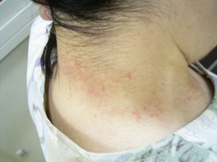 猛暑の皮膚トラブル「あせも」 - 南22条おとなとこどものクリニック 中央区南、幌南小学校前駅・東屯田通駅電停近く、内科・小児科