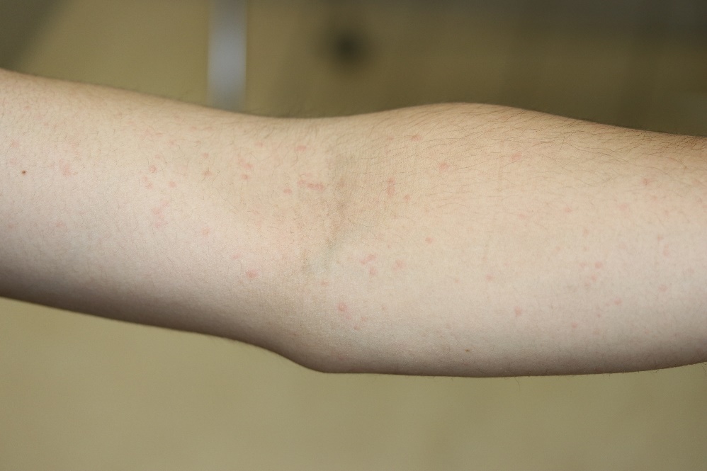 じんましんまつもと皮膚科クリニック福知山・丹波・丹波篠山市の皮膚科・美容皮膚科