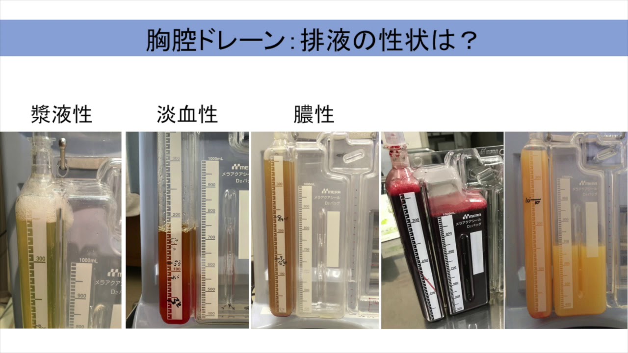 胸腔ドレーンの仕組みー三連ボトルシステムについて看護師学習ノート