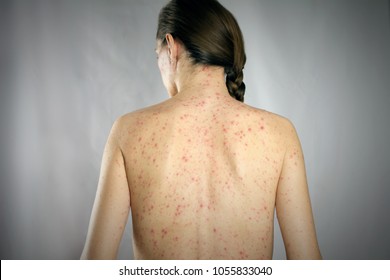 画像付き 帯状疱疹の初期症状とは？帯状疱疹予防.jp