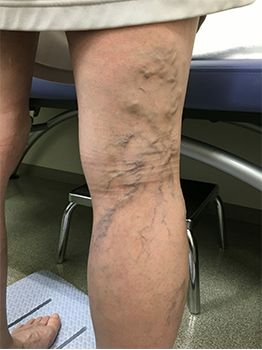 妊娠中の下肢静脈瘤原因と予防法を専門医が解説下肢静脈瘤のすべて症状・治療・予防がわかる総合情報サイト