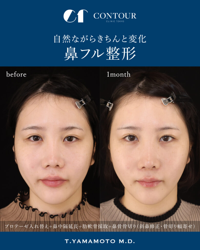 斜鼻修正術美容外科川崎クリニック大阪梅田院ホットペッパービューティ