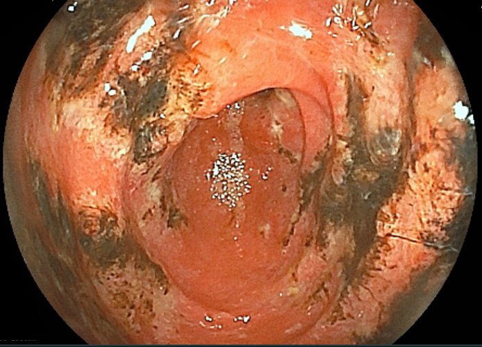 地方病日本住血吸虫症- Wikipedia