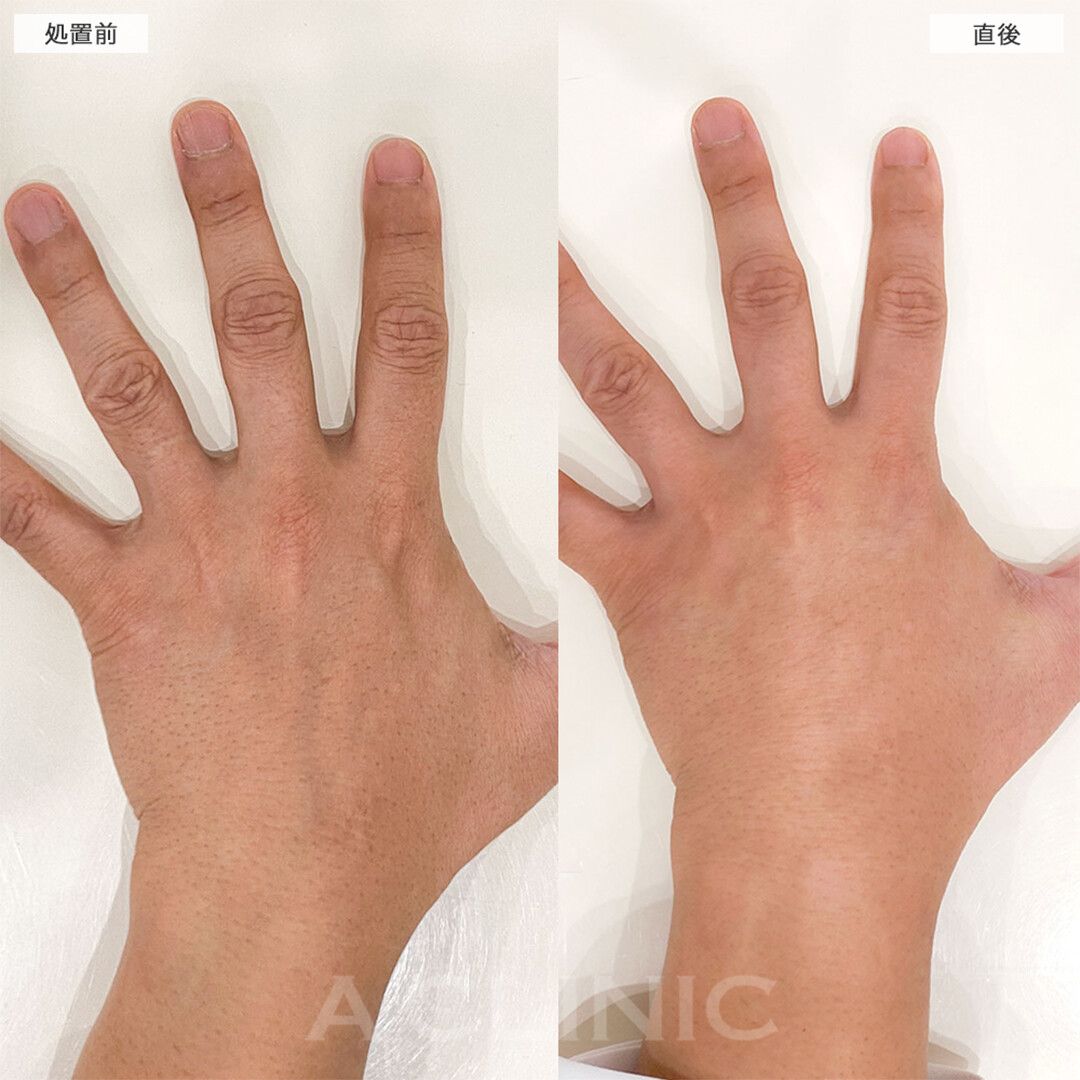 メンズ専門指・手の甲のニードル脱毛の実際の施術事例をご紹介