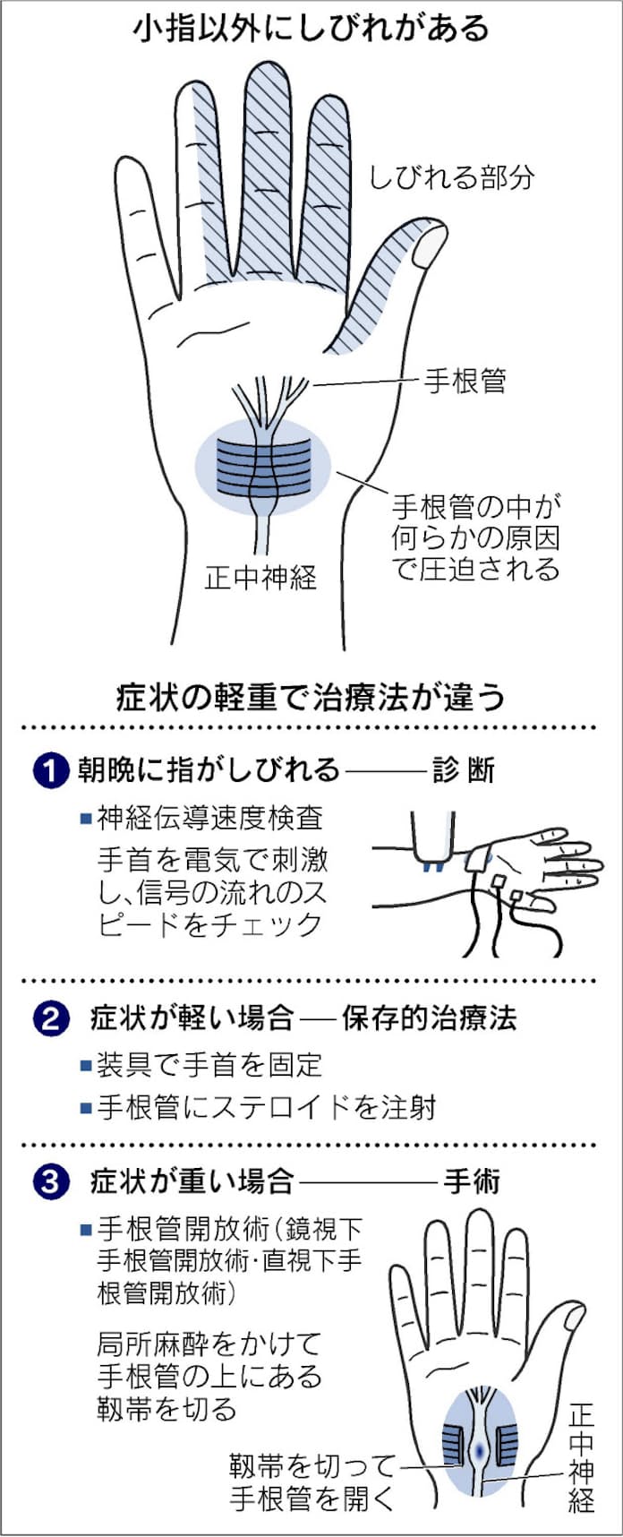 手根管症候群の原因と治療ヘルスきゅんと:宮日生活情報紙