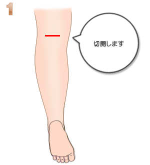 手術後231日目 33W 細くなった足首足首骨折 三果骨折 日記