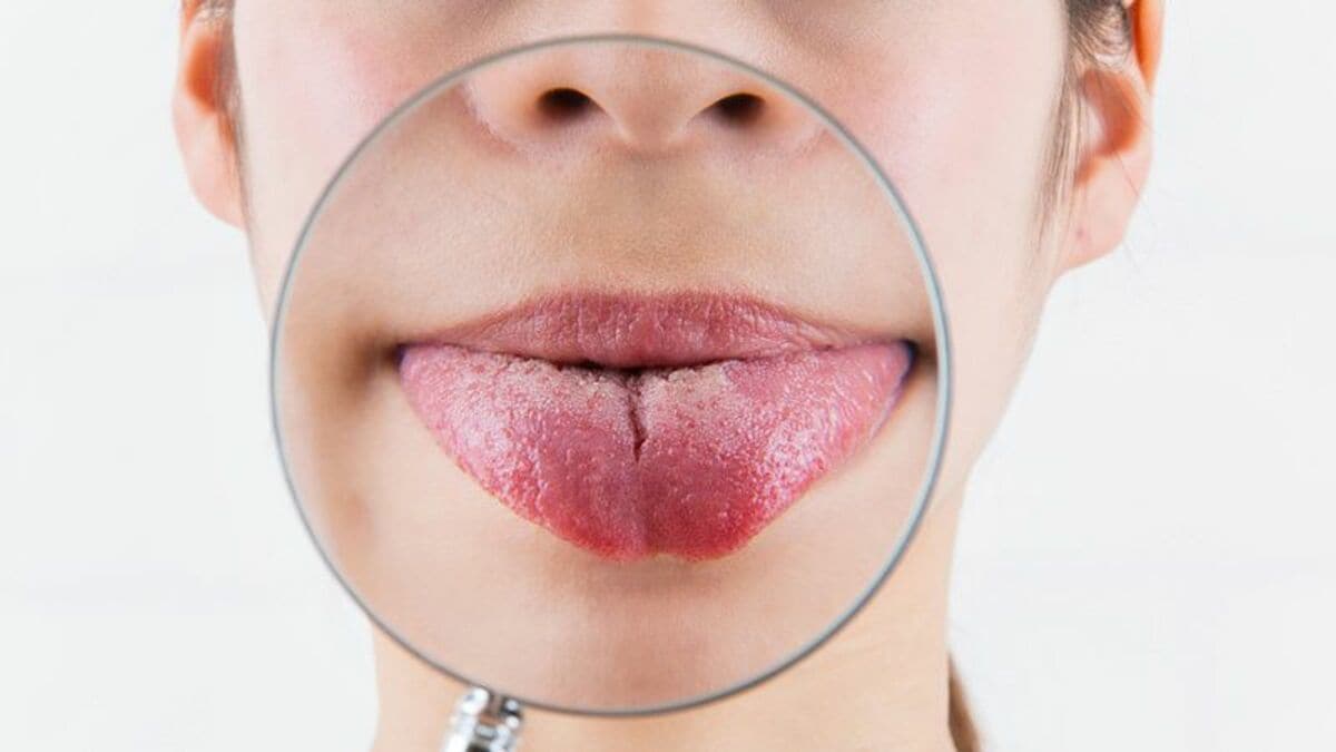 溝状舌 こうじょうぜつ とは 溝状舌の痛みの原因と対処法