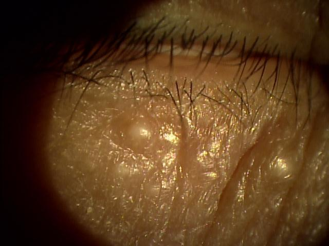 デリケートゾーン 陰部 のできものニキビ・しこり・イボなどの原因を解説wakanote