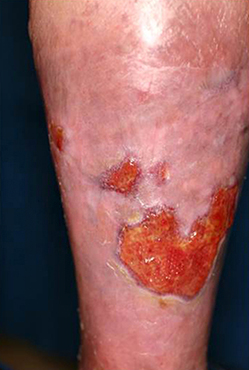 脂漏性皮膚炎 脂漏性湿疹 とは？写真つきでその原因や症状を医師が解説！ - オンライン診療ならウチカラクリニック