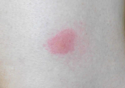 虫刺され高田馬場皮膚科・形成外科