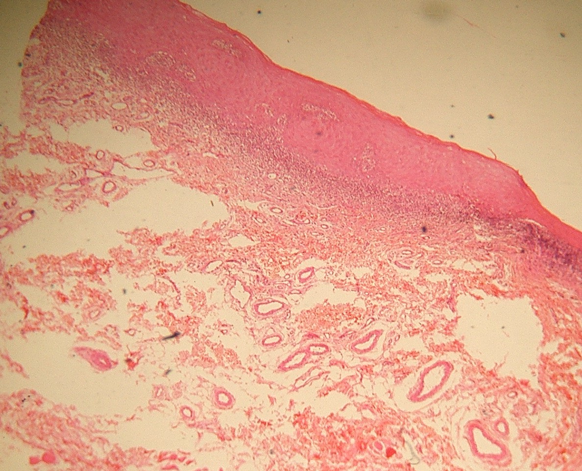 口腔扁平苔癬歯科口腔外科症例解説東京銀座シンタニ歯科口腔外科クリニック