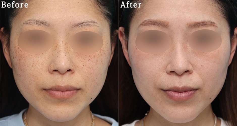 シミ取りレーザー後に起こる色素沈着Dr.TAKAKOの“花嫁美肌”の作り方