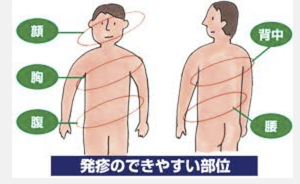 季節の変わり目に起こる「帯状疱疹」 - 東京ビジネスパーソンズクリニック