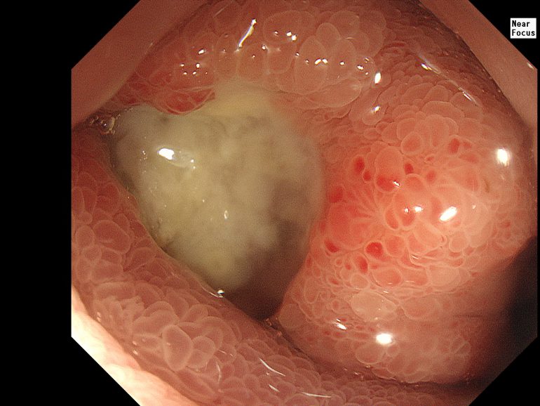 2025年最新 虫垂炎 盲腸 とは？症状・原因・腹腔鏡日帰り手術を大阪の専門医が解説