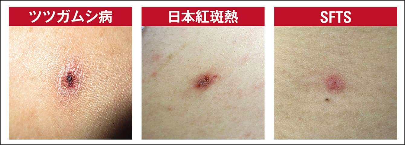 マダニによる感染症に注意しましょう石川県