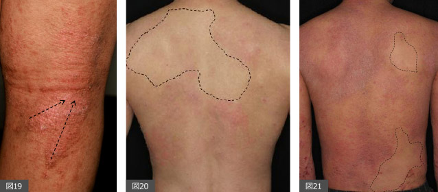 背中野田市 小児科 千葉県 こどもの花粉症 こどもの漢方 喘息 アトピー性皮膚炎 アレルギー 結節性痒疹 たんぽぽこどもクリニック