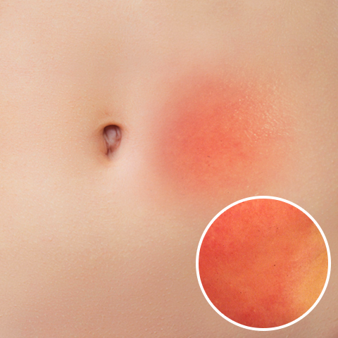 朝起きたら、お腹から胸辺りに湿疹が出来てたのですが、痒みなどはありません。- Yahoo!知恵袋