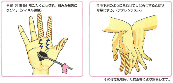 手がしびれる病気 手根管症候群をご存知ですか済生会小樽病院
