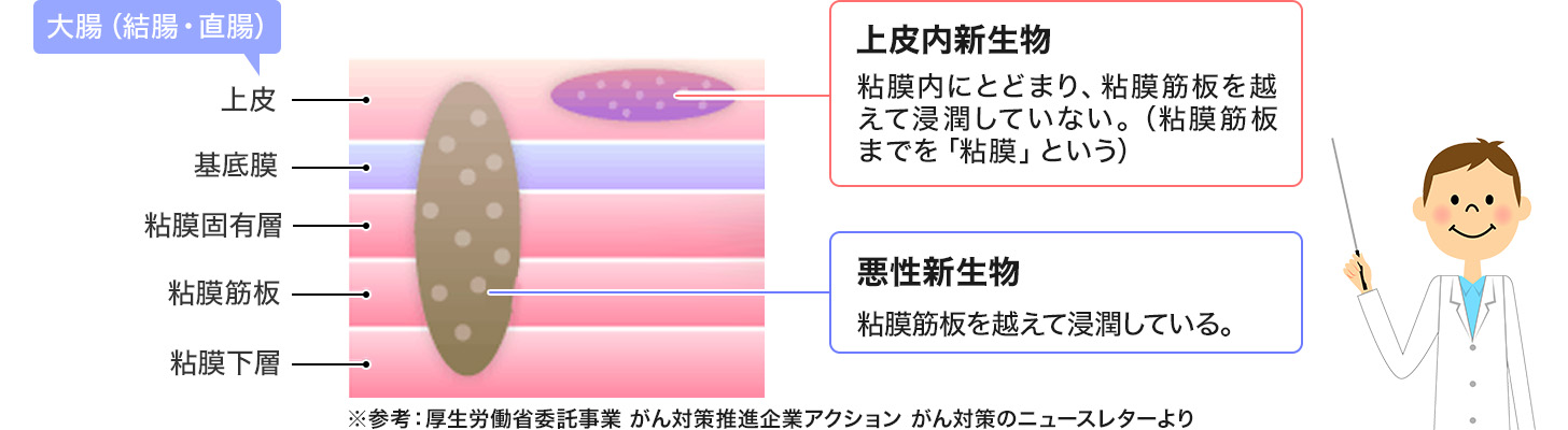 悪性新生物と上皮内がんの違いをベテラン医師がわかりやすく解説FP立川・吉祥寺・国分寺ファイナンシャルプランナー相談はファイナンシャルトレーナ