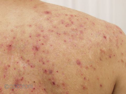 腰・おしりの丘疹皮膚トラブルの状態チェックヒフシルワカル