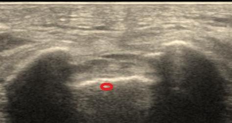 脊柱管狭窄症に硬膜外ブロックは効く？ 手術が必要なケースとは？2ページ目 ：名医が解説！ 最新治療トレンド：日経Gooday グッデイ