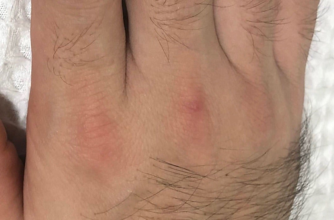 メンズ専門指・手の甲のニードル脱毛の実際の施術事例をご紹介