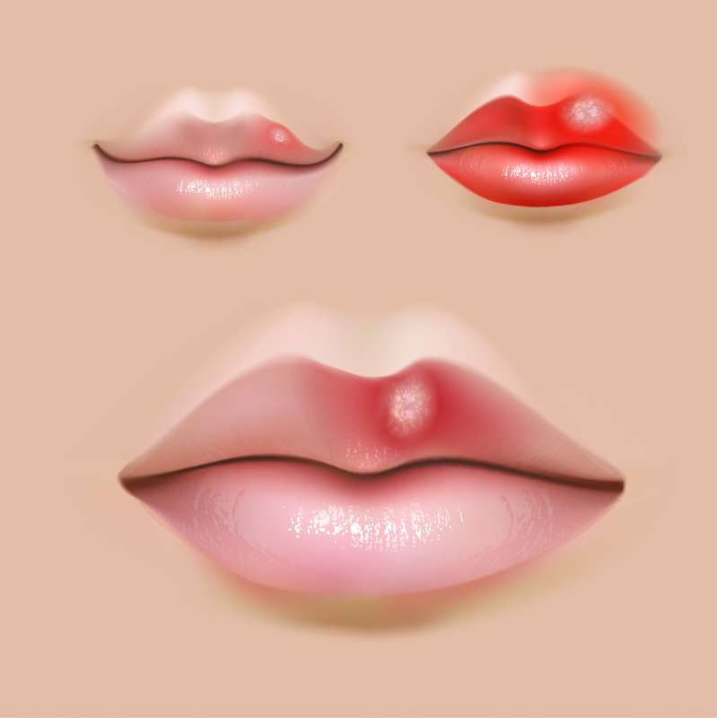 唇のプツプツがとれません。大丈夫ですか？ 3ページ目 ：日経メディカル