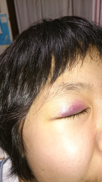 まぶたを押すと痛いのはなぜ？ 考えられる原因や対処法を紹介