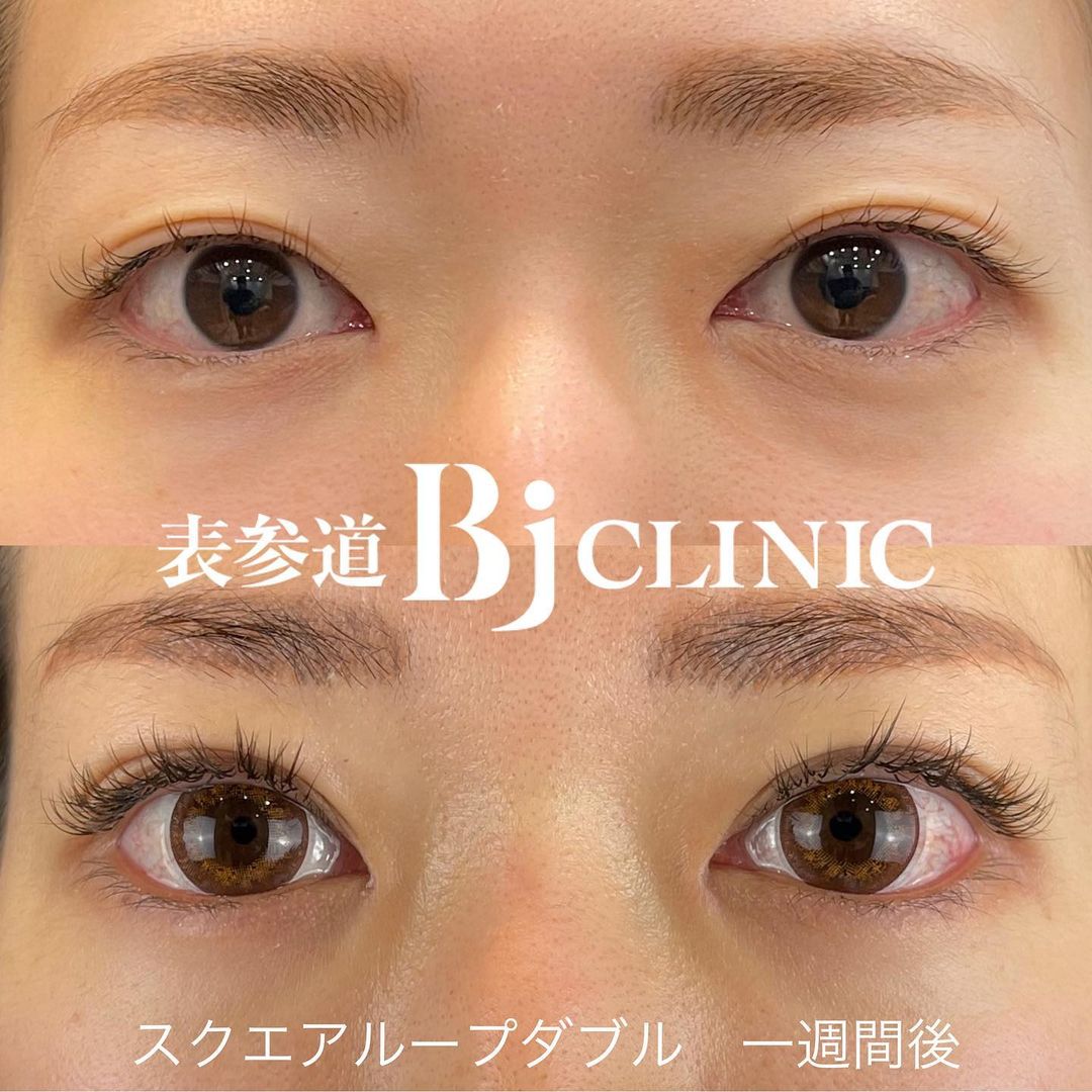 エラボトックスのおすすめクリニック！ どこがいい？値段や種類・デメリットも解説2025年マイベスト