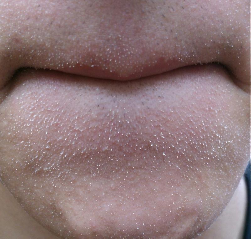 角栓が自然に取れるのを待つ「角質培養」がいいってホント？角栓を取らないとどうなる