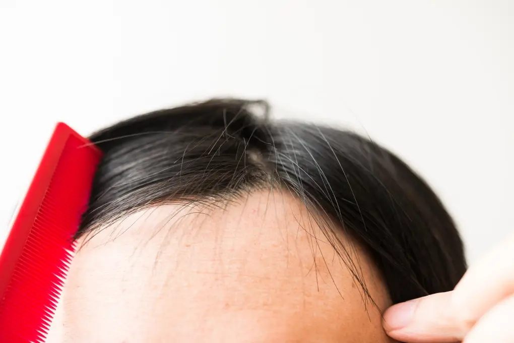 つむじはげは思い込み？基準や正常なつむじとの違い、頭頂部はげの治し方を解説B&Hメディカル