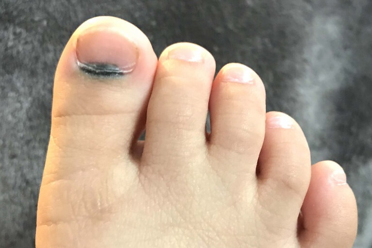 Shinji Ogawa「爪の根元が腫れて痛い」「爪が伸びてこない」→そんな時に疑うべき病気が「爪刺し」です。正式名称は「後爪郭部爪刺し」です。どんな病気なのか？Instagram