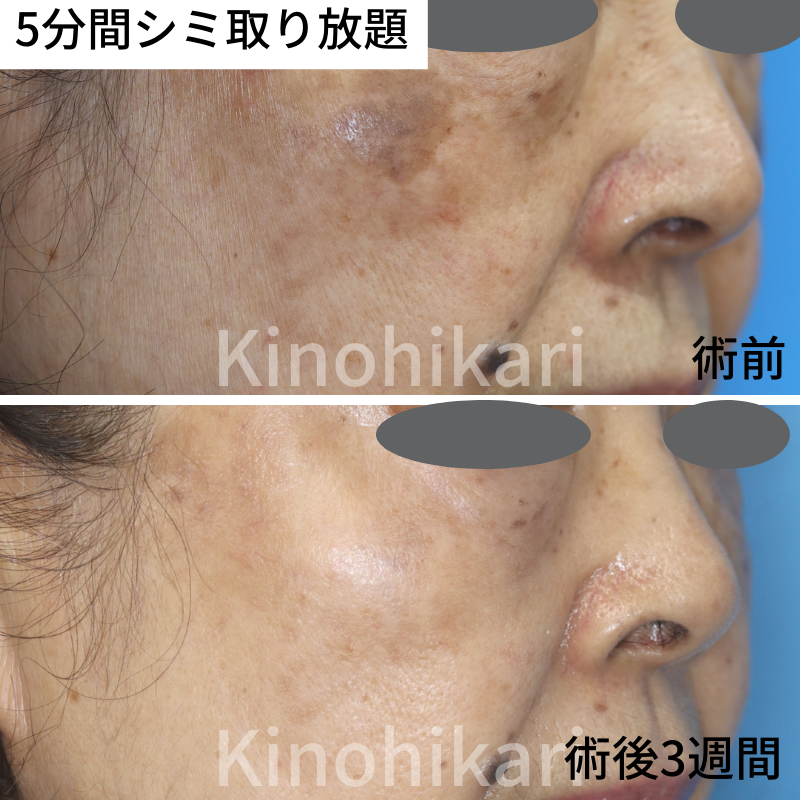 シミ取りレーザー体験記、術後の経過をブログで報告初日～20日目+半年後まで