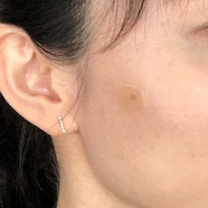 シミ取り放題レーザー治療⑤ その後の経過加藤優花オフィシャルブログ「海外セレブに憧れて」Powered by Ameba