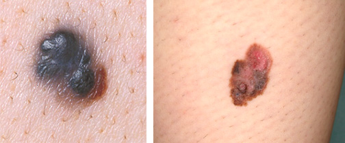 メラノーマ ほくろのがんQ2 - 皮膚科Q＆A 公益社団法人日本皮膚科学会